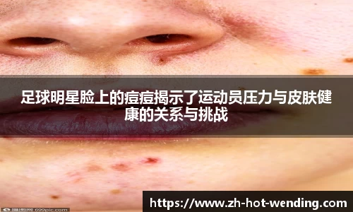足球明星脸上的痘痘揭示了运动员压力与皮肤健康的关系与挑战